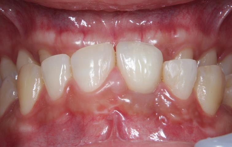 Case01 治療後の口腔内写真