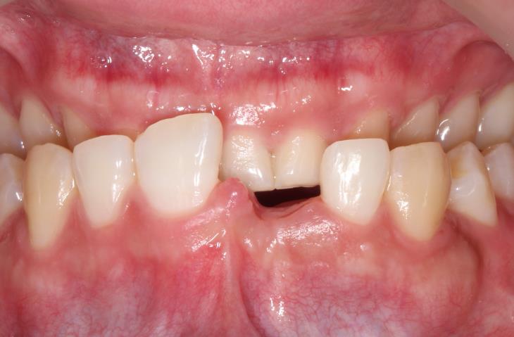 Case01 治療前の口腔内写真