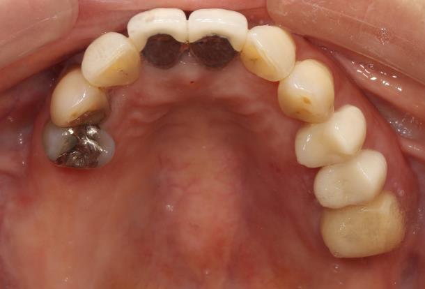 Case02 治療前の口腔内写真