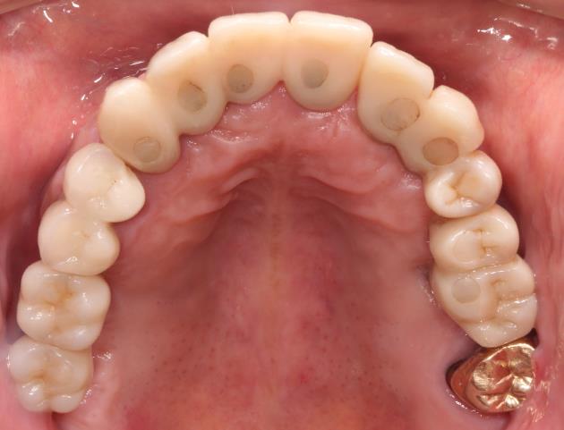 Case03 治療後の口腔内写真