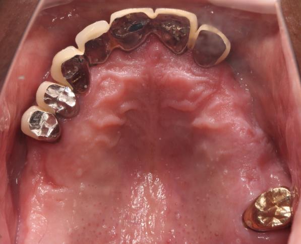 Case03 治療前の口腔内写真