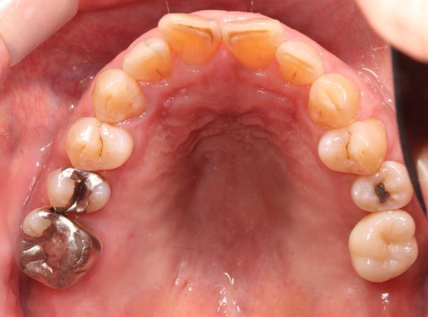 Case04 治療後の口腔内写真