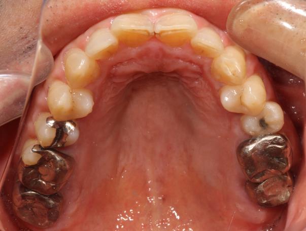 Case04 治療前の口腔内写真