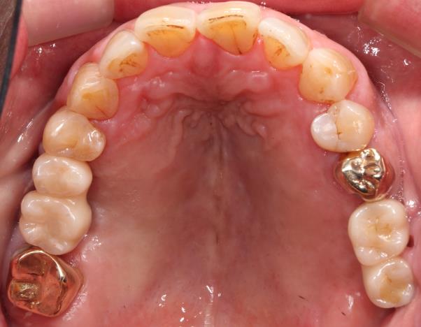 Case05 治療後の口腔内写真