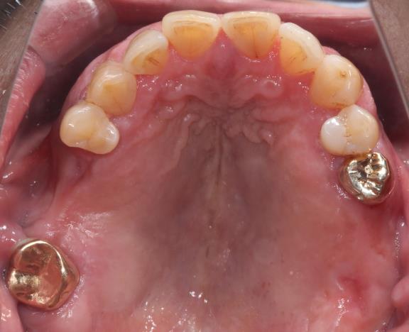 Case05 治療前の口腔内写真