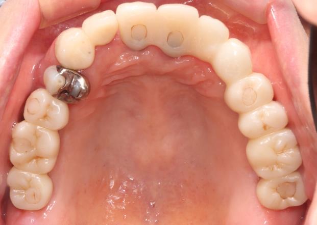 Case06 治療後の口腔内写真