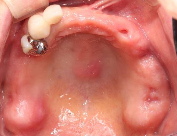 Case06 治療前の口腔内写真