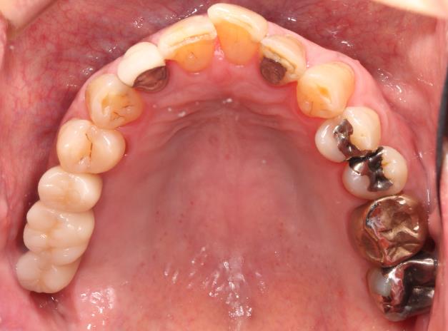 Case07 治療後の口腔内写真