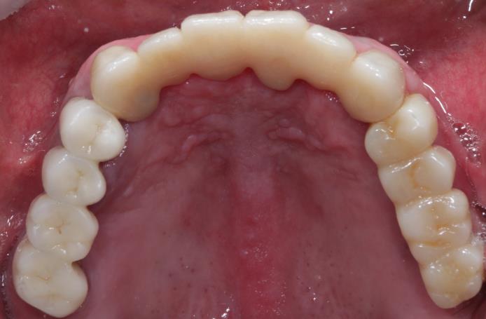 Case09 治療後の口腔内写真