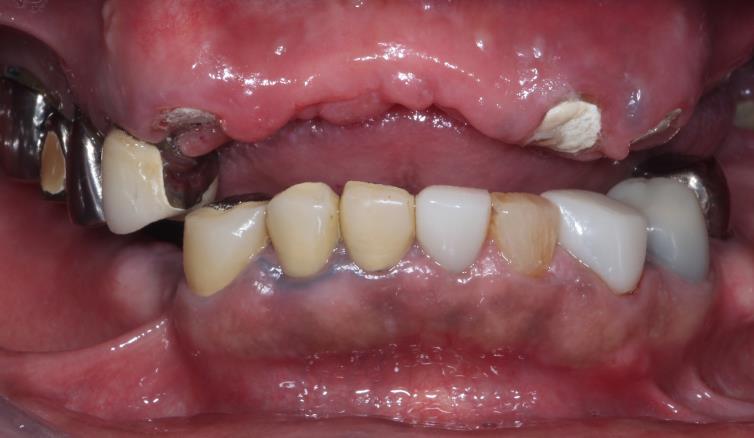 Case09 治療前の口腔内写真