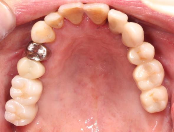 Case10 治療後の口腔内写真