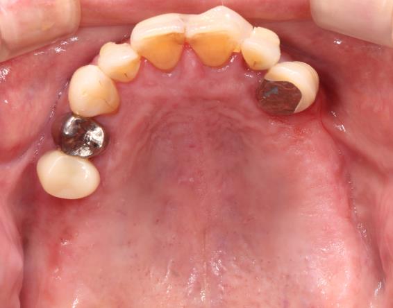 Case10 治療前の口腔内写真
