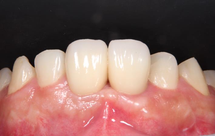 Case11 治療後の口腔内写真