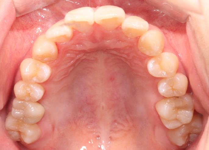 Case13 治療後の口腔内写真