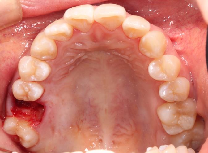 Case13 治療前の口腔内写真