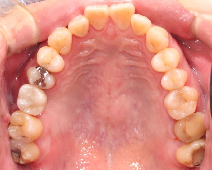 Case14 治療後の口腔内写真