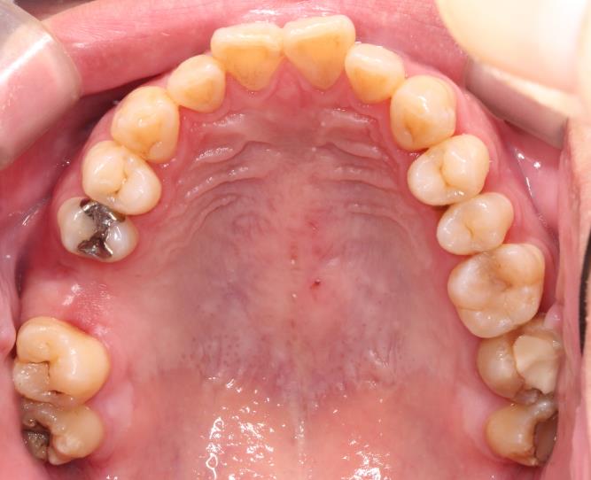 Case14 治療前の口腔内写真