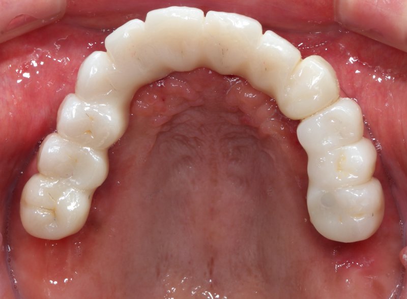 Case20 治療後の口腔内写真